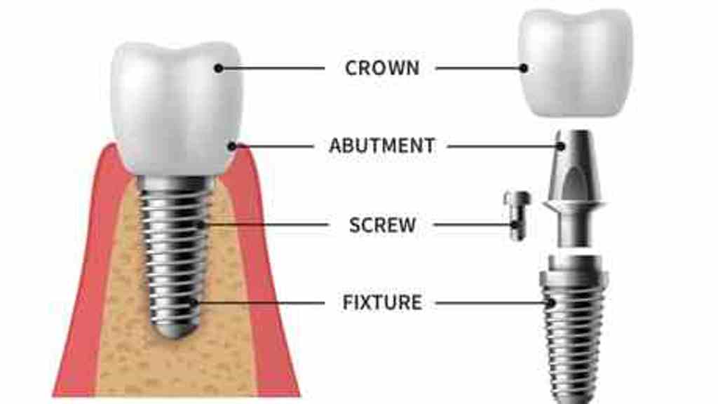 Best Dental Implant in Rajarhat