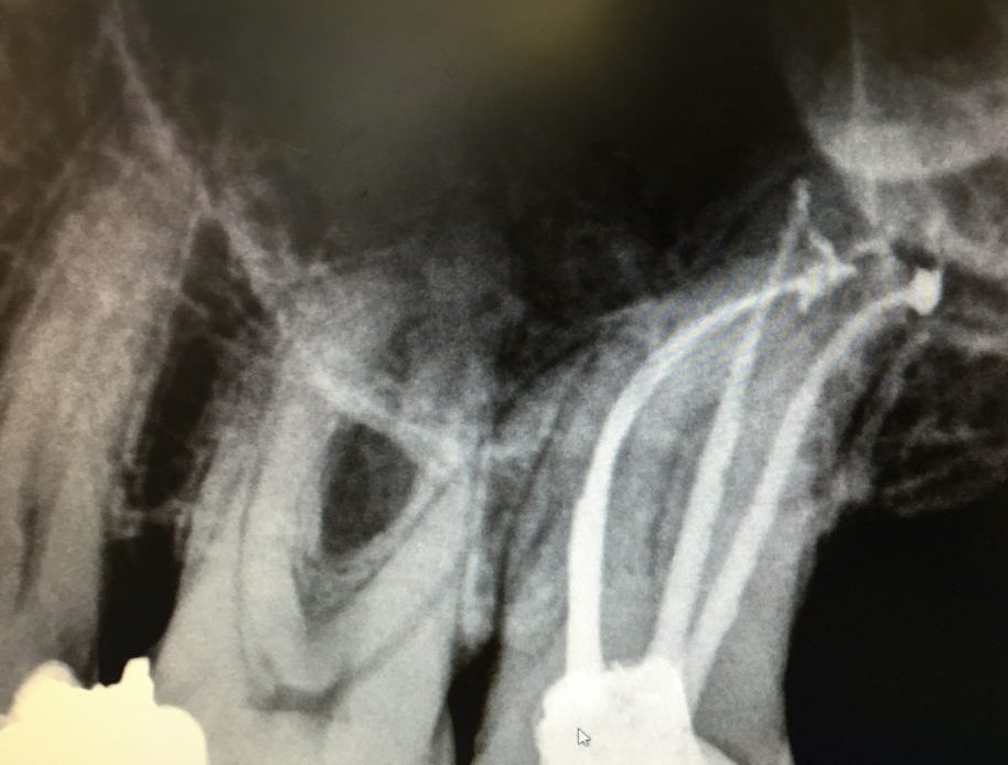 Root Canal treatment at Rajarhat Dental Hall