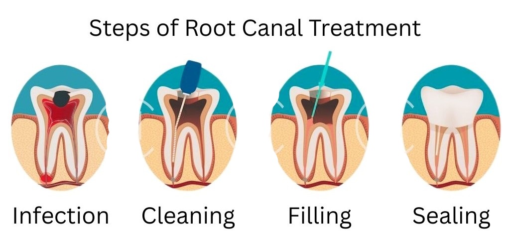Root Canal Treatment
